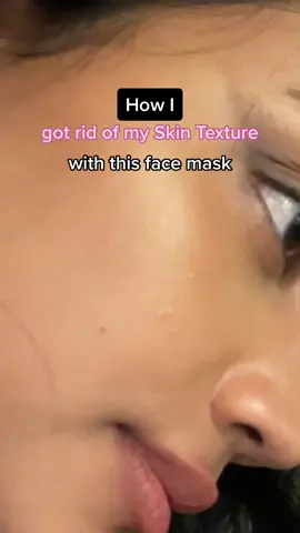 Since my last video blew up here’s another one lol 💗☺️ #clearskin #acne #skincare #skincareroutine