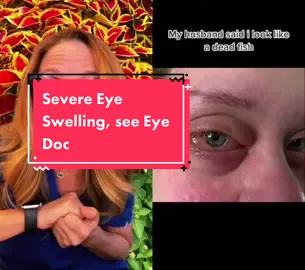 #duet with @theharpiequeen  please see your eye doctor, this looks like more than allergies. #eyeinfection #eyehealth #eyedoctor #allergy