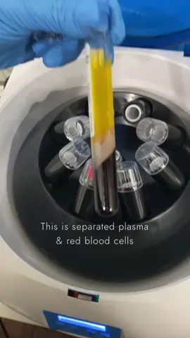 Microneedling with Prp! 💉🩸 #nowlookatthis #Beautyhack #Lifestyle #prp #skincare #nurseliat