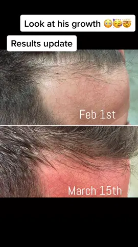Results update!!! Want to stop your hair loss?? Feel free to message me, comment, or visit my website in my bio! #mabrowsandhair #hairloss