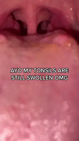 I wanna cut them out #swagtownn #swollentonsil #fyp #uhohnotagain