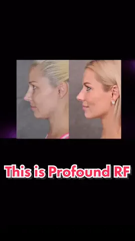 I love this procedure because it’s non-invasive and you only need to do it ONCE. #profoundrf #microneedling #radiofrequency #facelift #plasticsurgery