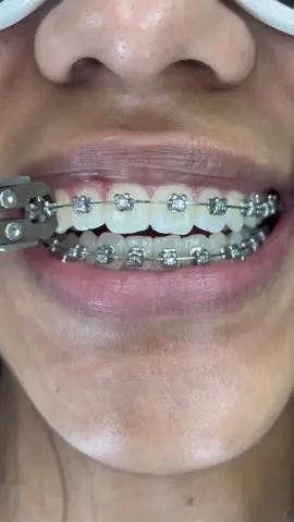 Braces off!🤩 #Orthodontist #dentist #Orthotricks #LearnOnTikTok #satisfy #foryou
