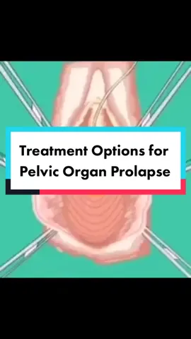 Treatment options for Pelvic Organ Prolapse #pelvichealth #prolapse #prolapsedbladder #pelvicorganprolapse #pessary #pelvichelp #urogynecologist