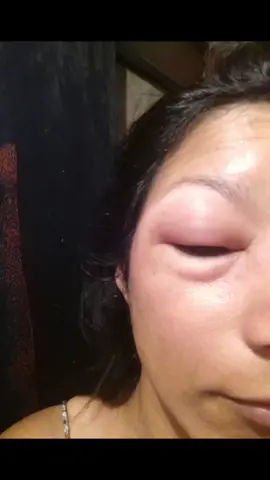 Hace rato quería hacer este video,26/2/2018 amanecí cn el ojo derecho hinchado,nunca supe que fue lo que me paso pero gracias a Dios no quedo secuelas