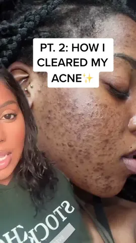 Part 2: How I cleared my acne ✨#howigotridofacne #acnebeforeandafter #acne.org #beforeandafter #blackgirlacne