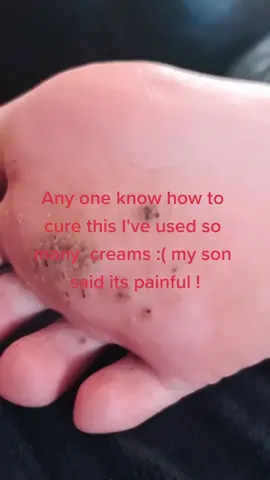 #Foot#verucca#skin problems
