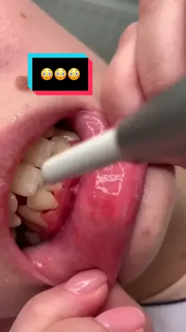 Yea so if your gums do dis you need to brush yo teeth 😳 #LearnOnTikTok #tiktokpartner #teeth
