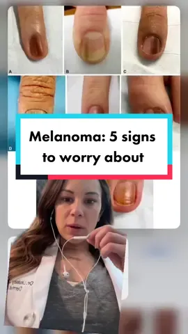 10/10 chance you’re looking at your nails now  #skincancer #melanoma #skincancerawareness #derm #dermatologist #dermguru