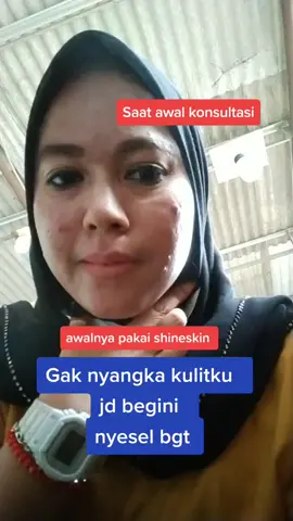 gak nyangka kulit ku jd begini, auto nyesseeel #skincardjedawat #skincareviral #jerawstampuh #jerawathilang #kulitbersih #fyp