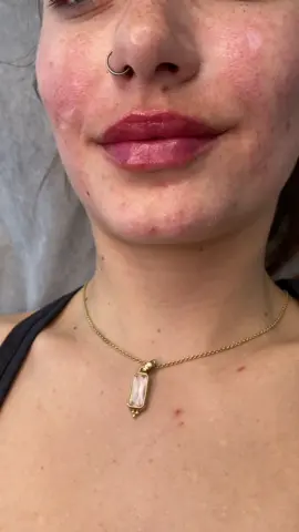 Before and after lip fillers 💉💋 #NurseLiat #LipFiller #LipsByLiat #versa #revanesse #lipfillers