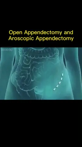 What kind of appendectomy did you use? #appendectomy #process #surgery #foryou #health #fypシ