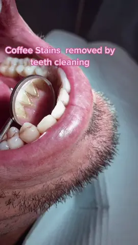 Coffee stains your teeth! #teethcleaning #prophy #whiteteeth #dentist #dentistry #smile #makeup