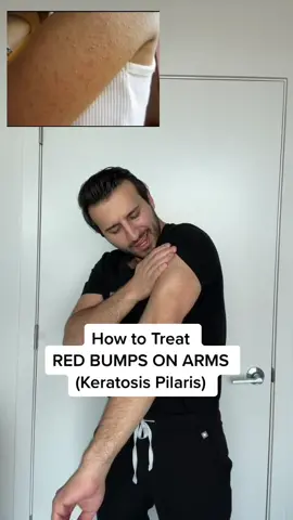 KP hacks!! #keratosispilaris #skincarehacks #skincareshoping