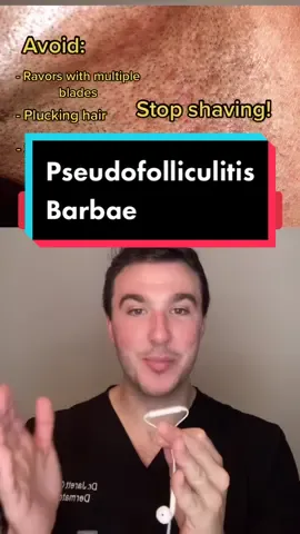 Pseudofolliculitis barbae! #derm #dermondemand #skin #hair #pseudofolliculitis