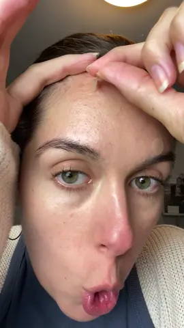 Don’t pick, just patch 💁🏻‍♀️ AD @herocosmetics #heropartner #herocosmetics #pimplepatch #mightypatch #skincare #acne