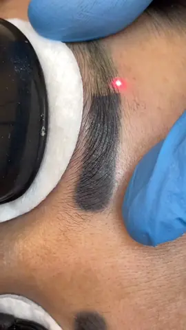 Лазерное удаление татуажа бровей. Slow motion video. #batumi #laser #lasertattooremoval