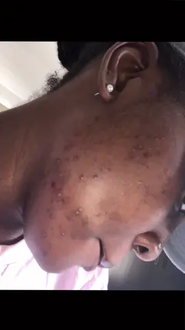 My acne journey. #acne #hormonalacne  #skincarehack  #blackgirlacne #acnebeforeandafter #hyperpigmentation #foryoupage #melanin #blackgirlskincare