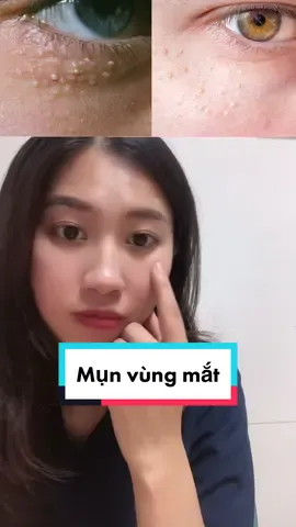 Mụn thịt ? #bskhonghanhnguyen #skincare #LearnOnTikTok #SquidGame