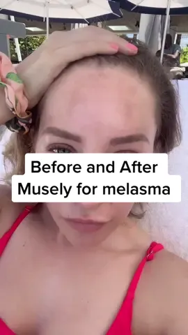 This is NOT an ad I’m just a blown away customer! @musely #musely #beforeandafter #skin #skincare #foryou #fyp #transformation #melasma