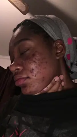 my skin isn’t perfect but i came a long way😭 #greenscreen #skin #skintok #dusty #fyp #fypシ