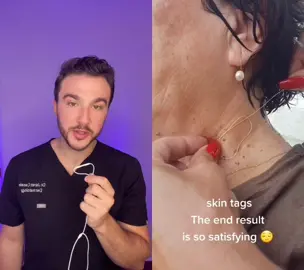 #duet with @aesthetics_bymel save your skin tags for us #derm #dermatology #skintags #skin #fyp