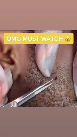Perfect garnish 😰😂 #ingrownhair #pimplepop #foryoupage #fypシ #doctorsoftiktok #extractions #dermatologist #dermdoctor #drpimplepopper