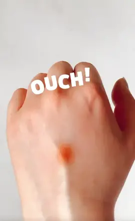 Don’t pull the stinger out! Flick it 🐝 #beesting #babyfirstaid