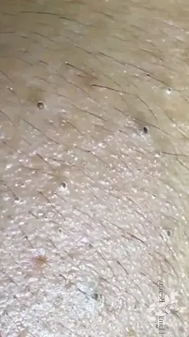 Where are you guys from??🤩#fyp #pimple #acne #blackheads #blackhead #foryou
