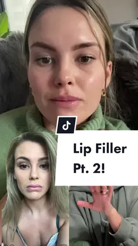 Here’s part two of my lip filler/lip flip journey #fillers #lipflip #lipflipresults #medspa #chicagomedspa #lipfillers #storytime #greenscreen lips done by @Ashley Louise in Chicago!