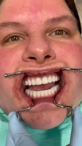 Patient from Wisconsin📍#allonx #newsmilecheck #dentalimplants #oralsurgery #wisconsincheck