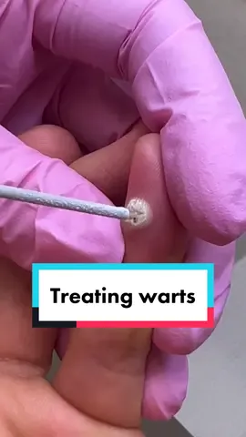Various strains of HPV cause warts #wart #dermatologist #liquidnitrogen #satisfying