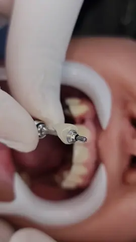 🔩🦷🔧🦷 Implante dentário + coroa zircônia.#zirconiacrown#implantedental#odontologiaestetica