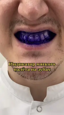 Столько налёта скапливается на зубах в течении дня.
