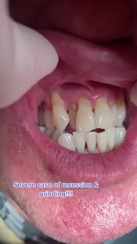 Anyone has this going on?! #grinding #recession #periodontaldisease #perio #dentist #dentistry #teeth #ortho