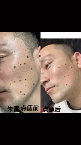 #点痣 #祛痣 #祛痣祛疣祛斑祛痘 #