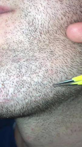 Pulling out beard pili multigemini #pick #plucking #hairtok