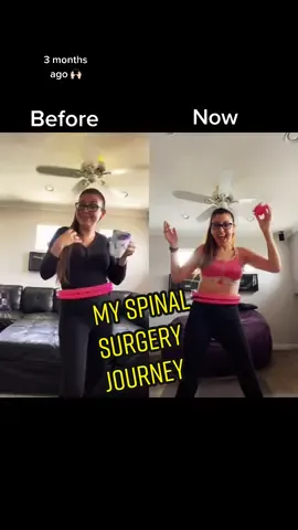 #duet with @leenie143to42 10 months #postop #beforeandafter #spinalfusion #hulahoopchallenge #weightlosscheck #hula #cardio #workout #titanium