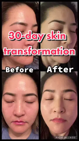 #omniluxtherapy #omnilux #omniluxledlighttherapy #30daytransformation #skincare #SkinCare101 #wow #redlighttherapy