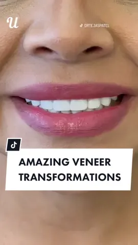 This cosmetic dentist transforms people’s smiles! 😁 (@Tejas Patel, DDS) #veneers #cosmeticdentist #dentist #transformation #makeover #fyp #foryou