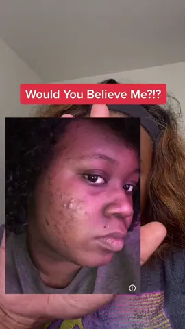 Follow me for more beauty and skin care recommendations! #acne #skincare