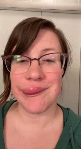 My body the night before I start a new job 💫 #angioedema