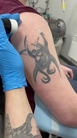 Can you tell what it is yet? #lasertattooremoval #satisfying #satisfyingvideo #skincare #skin #lovetheskinyourein