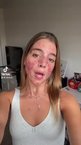 Lo hice ❤️ #accutanecheck #fyp #acne