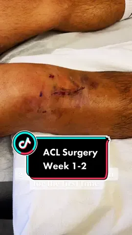 ACL Surgery Week 1-2 😤 #aclsurgery #aclrecovery #kneesurgery #kneepain #aclrecovery