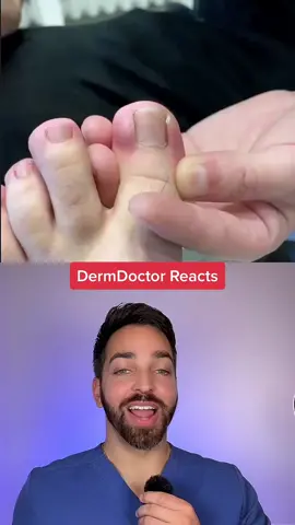 Pincer nail @doctor_toenails #dermdoctor #pincernail #ingrowntoenail #dermatologist