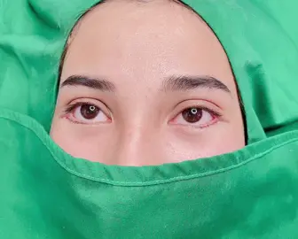 Mở góc ngoài mắt !