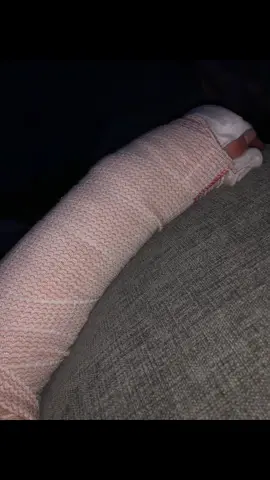 #brokenarm #radiosbone #brokenarmshit #fyp #splint #sling #cast