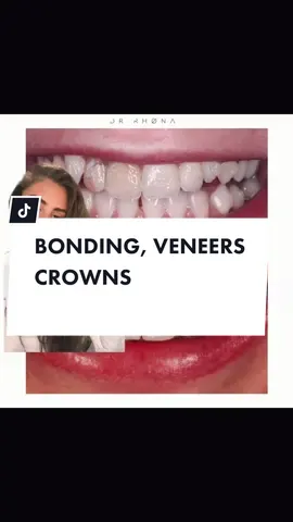 #stitch with @taycericketts dentists explanation #dental #teeth #bonding #whitening #beauty #Love #happiness #veneers #smiles #dentist #fyp #crownsteeth #smiles