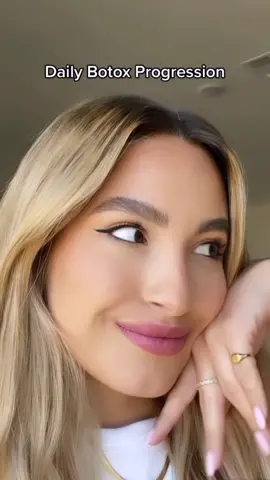 Wedding prep with @revive.md  💕 You’ll want to do your Botox a little over 14 days out from your big day as it takes time to see the full results. Any questions? I’ll answer them below from my experience! #wedding